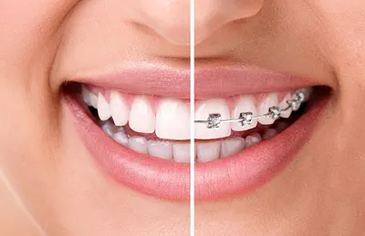 Ortodonta Żory. Bartosz Słomian. Aparaty ortodontyczne